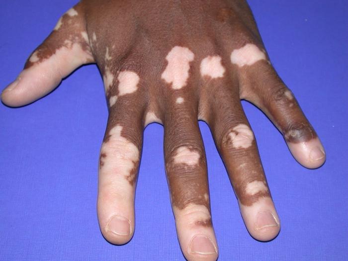 Årsager til vitiligo