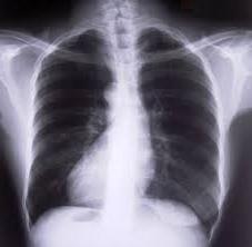 Årsager og symptomer på kronisk obstruktiv bronkitis. Dens diagnose og behandling